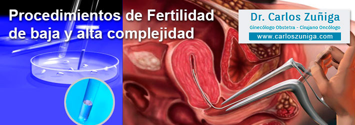 Procedimientos de Fertilidad de baja complejidad.